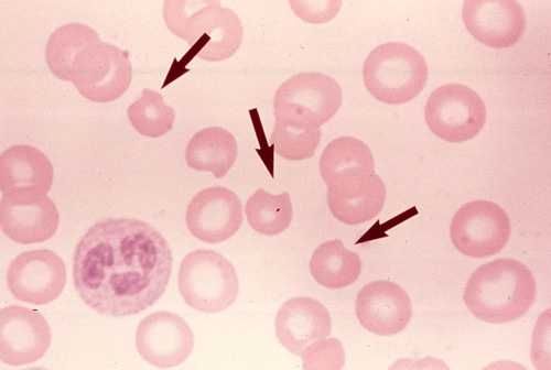 Χαρακτηριστική εικόνα με τα «Bite cells» κατά την διάρκεια της αιμόλυσης από ανεπάρκεια του ενζύμου G6PD