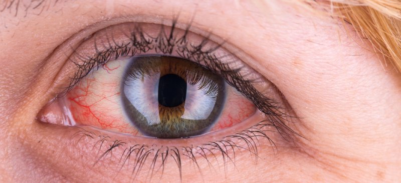 sjogrens syndrome