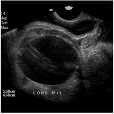 us_ovarian_torsion